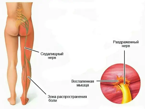 Седалищный нерв