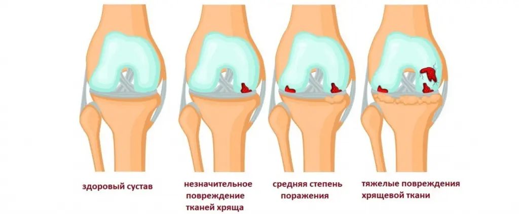 Что происходит с коленным суставом при гонартрозе