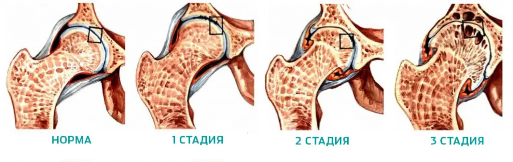 Стадии коксартроза