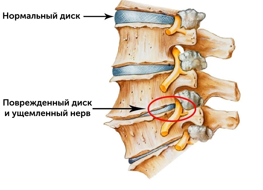 Изменение позвонков при остеохондрозе