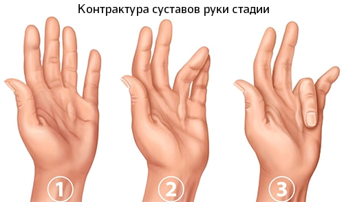Стадии развития контрактуры в суставах руки
