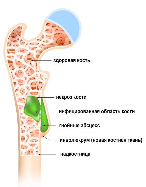 Патогенез остеомиелита