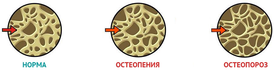 Степени остеопении