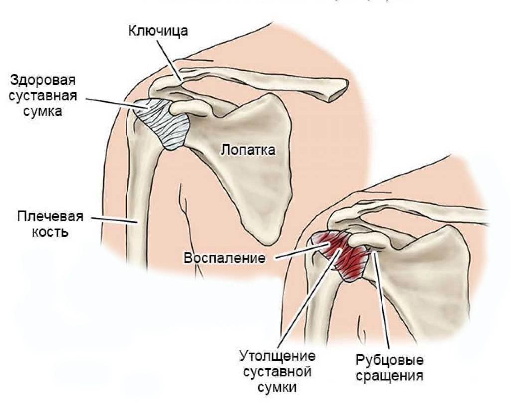 Плечелопаточный периартрит