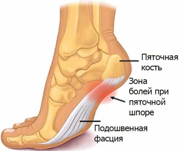 Воспаление подошвенной фасции