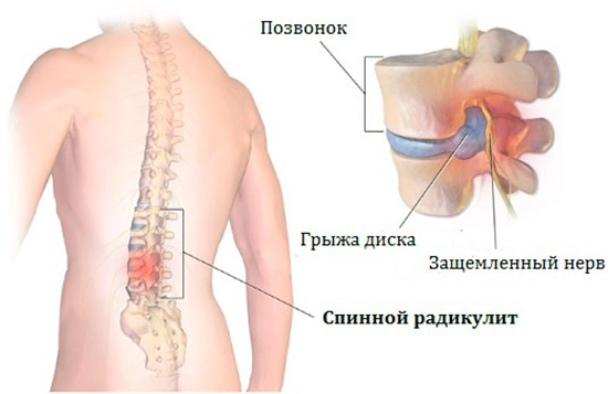 Защемление нервного корешка при радикулите