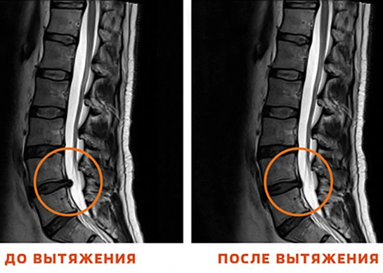 Грыжа до вытяжения и после